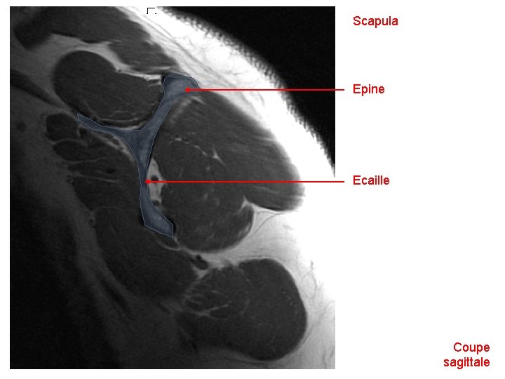 Scapula Epine Ecaille Coupe sagittale 