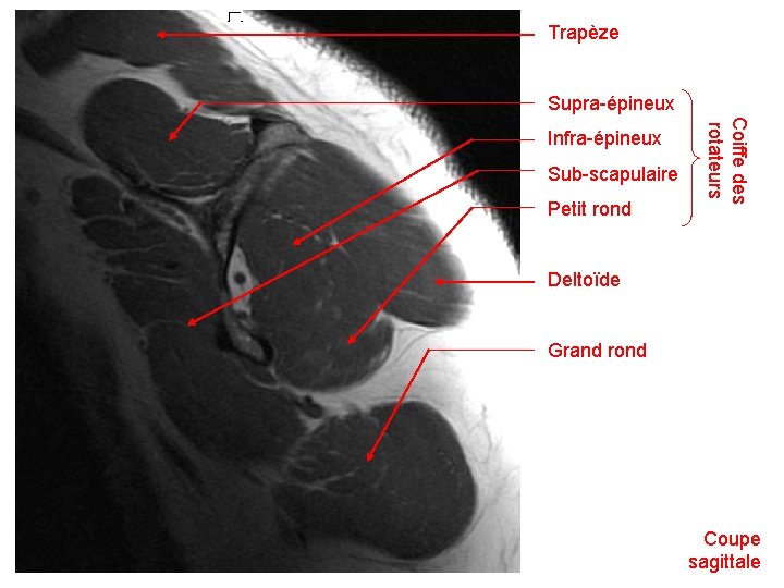Trapèze Supra-épineux Sub-scapulaire Petit rond Coiffe des rotateurs Infra-épineux Deltoïde Grand rond Coupe sagittale