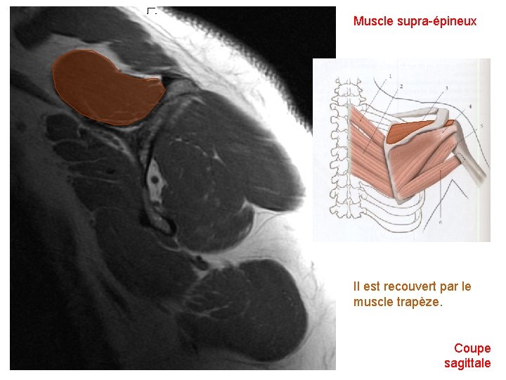 Muscle supra-épineux Il est recouvert par le muscle trapèze. Coupe sagittale 