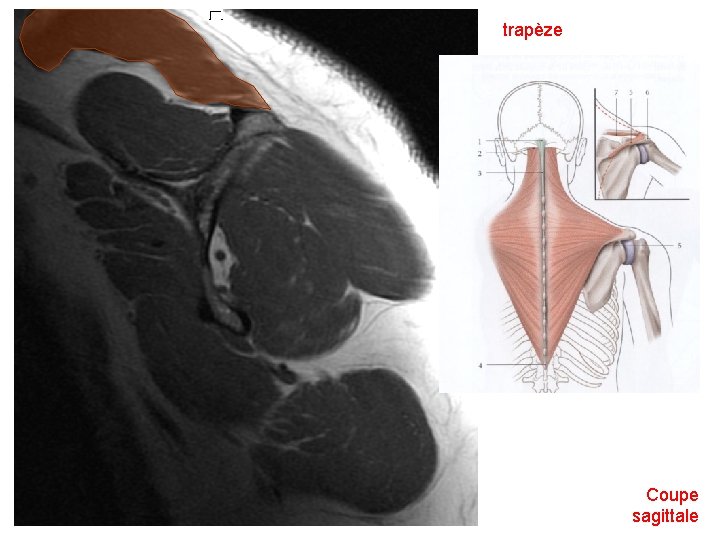 trapèze Coupe sagittale 