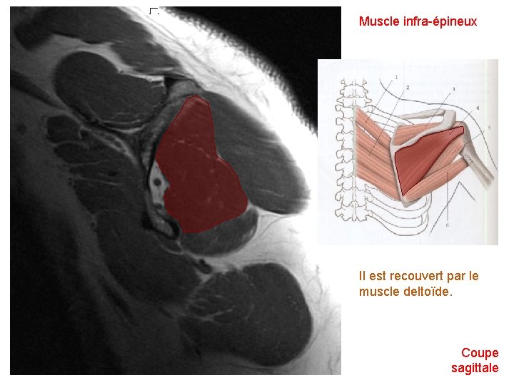 Muscle infra-épineux Il est recouvert par le muscle deltoïde. Coupe sagittale 