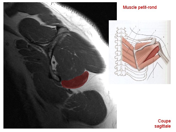 Muscle petit-rond Coupe sagittale 