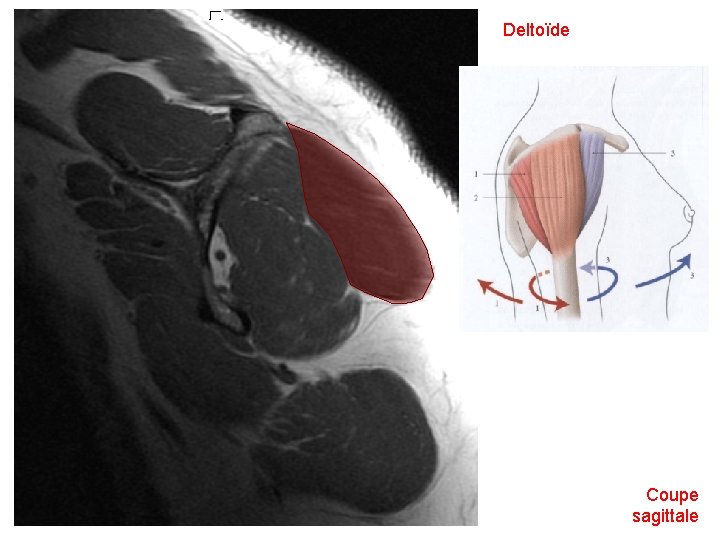 Deltoïde Coupe sagittale 