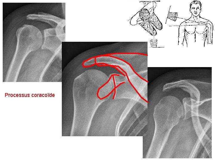 Processus coracoïde 