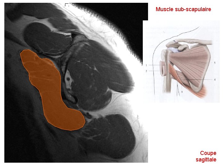 Muscle sub-scapulaire Coupe sagittale 
