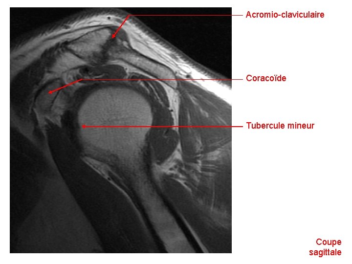 Acromio-claviculaire Coracoïde Tubercule mineur Coupe sagittale 