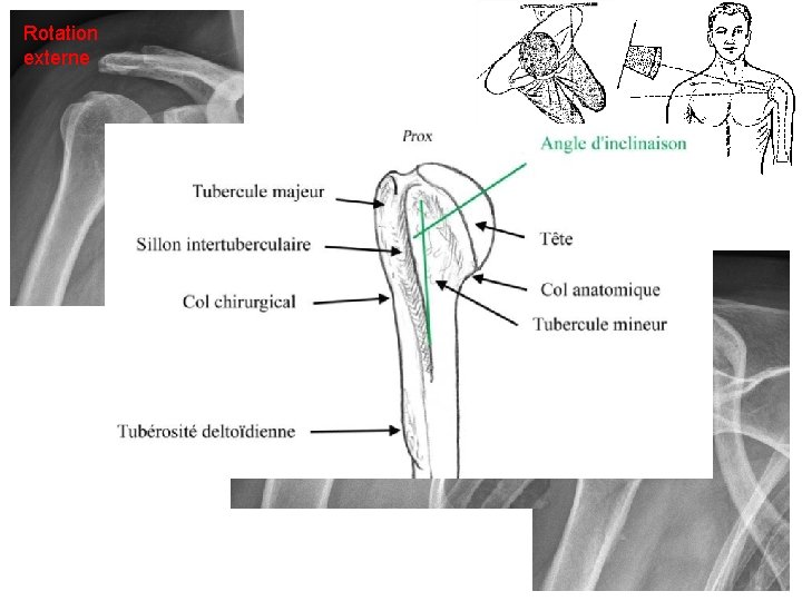 Rotation externe Rotation neutre Rotation interne 