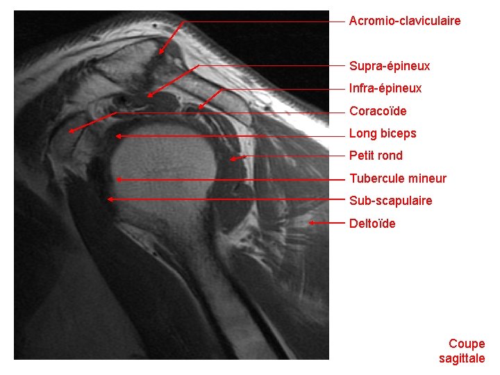 Acromio-claviculaire Supra-épineux Infra-épineux Coracoïde Long biceps Petit rond Tubercule mineur Sub-scapulaire Deltoïde Coupe sagittale