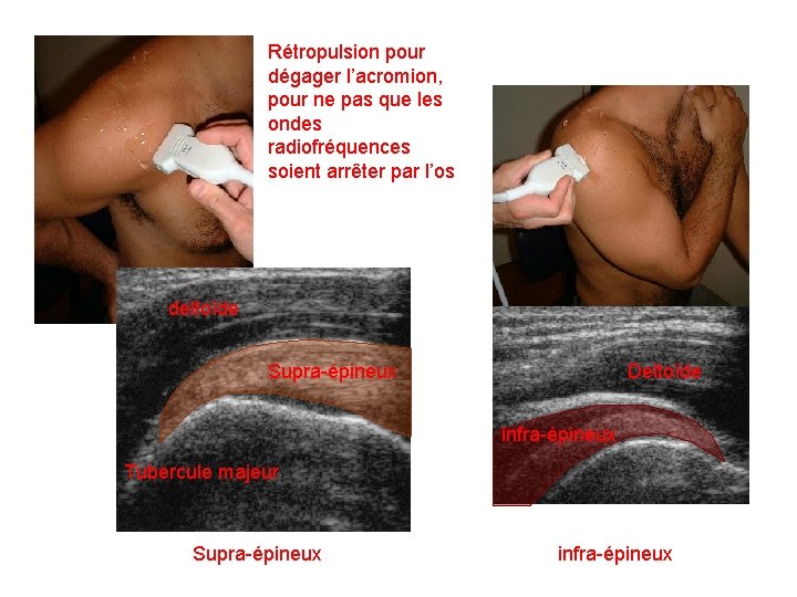 Rétropulsion pour dégager l’acromion, pour ne pas que les ondes radiofréquences soient arrêter par