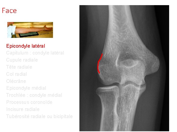 Face Epicondyle latéral Capitulum : condyle latéral Cupule radiale Tête radiale Col radial Olécrâne