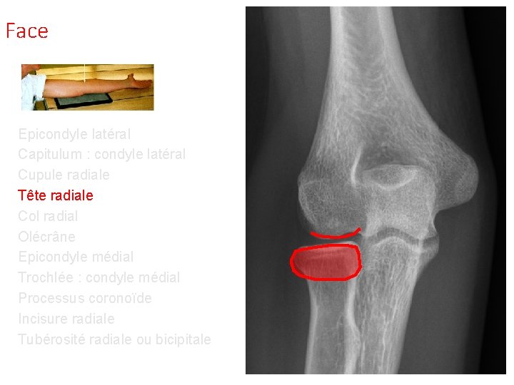 Face Epicondyle latéral Capitulum : condyle latéral Cupule radiale Tête radiale Col radial Olécrâne