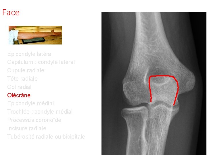 Face Epicondyle latéral Capitulum : condyle latéral Cupule radiale Tête radiale Col radial Olécrâne