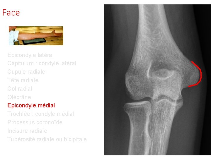 Face Epicondyle latéral Capitulum : condyle latéral Cupule radiale Tête radiale Col radial Olécrâne