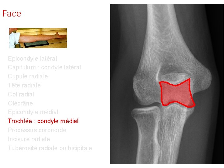 Face Epicondyle latéral Capitulum : condyle latéral Cupule radiale Tête radiale Col radial Olécrâne