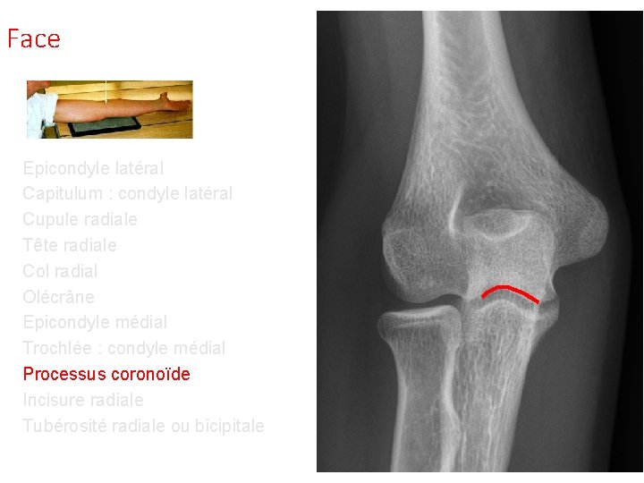 Face Epicondyle latéral Capitulum : condyle latéral Cupule radiale Tête radiale Col radial Olécrâne