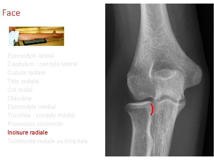 Face Epicondyle latéral Capitulum : condyle latéral Cupule radiale Tête radiale Col radial Olécrâne