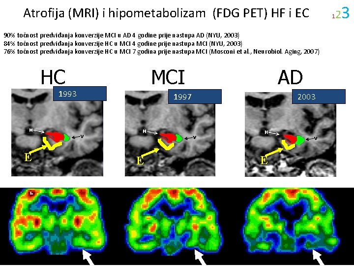  Atrofija (MRI) i hipometabolizam (FDG PET) HF i EC 90% točnost predviđanja konverzije