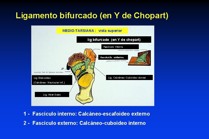 Ligamento bifurcado (en Y de Chopart) MEDIO-TARSIANA : vista superior lig bifurcado (en Y