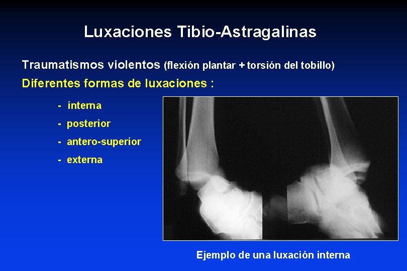Luxaciones Tibio-Astragalinas Traumatismos violentos (flexión plantar + torsión del tobillo) Diferentes formas de luxaciones