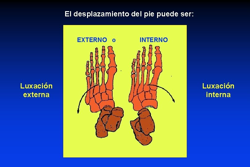 El desplazamiento del pie puede ser: EXTERNO o Luxación externa INTERNO Luxación interna 