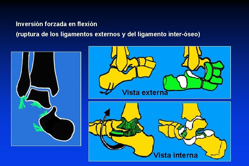 Inversión forzada en flexión (ruptura de los ligamentos externos y del ligamento inter-óseo) Vista