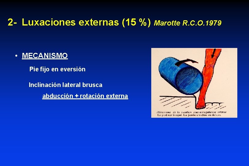 2 - Luxaciones externas (15 %) Marotte R. C. O. 1979 • MECANISMO Pie