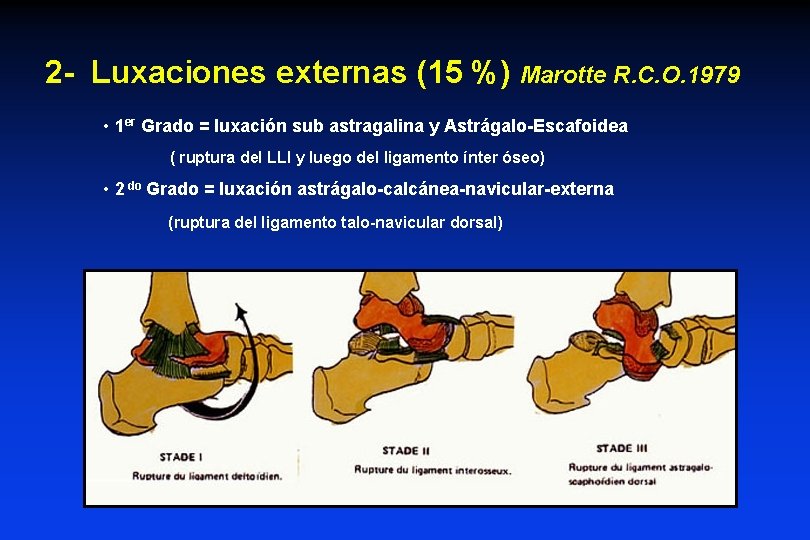 2 - Luxaciones externas (15 %) Marotte R. C. O. 1979 • 1 er