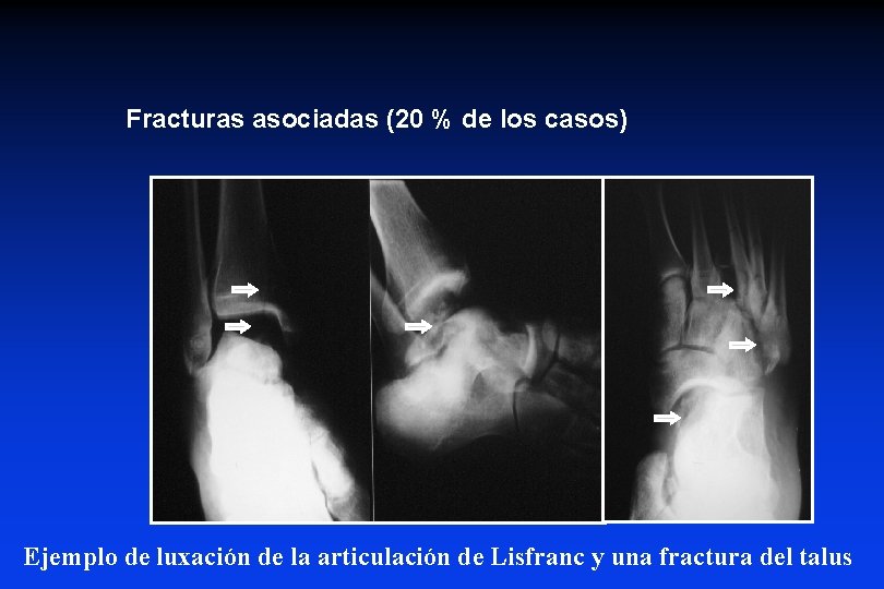 Fracturas asociadas (20 % de los casos) Ejemplo de luxación de la articulación de