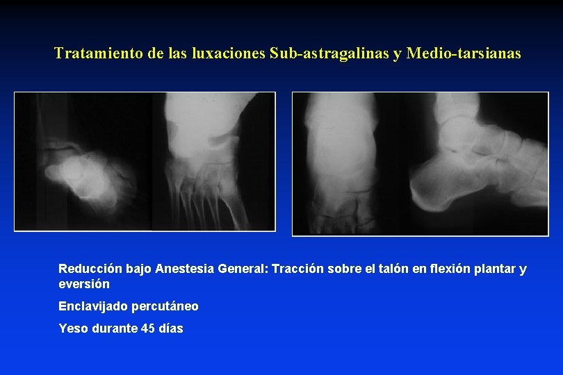 Tratamiento de las luxaciones Sub-astragalinas y Medio-tarsianas Reducción bajo Anestesia General: Tracción sobre el