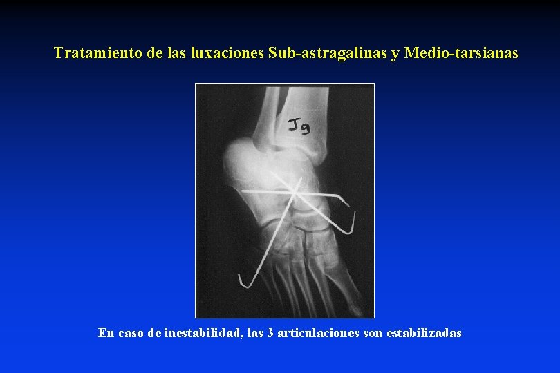 Tratamiento de las luxaciones Sub-astragalinas y Medio-tarsianas En caso de inestabilidad, las 3 articulaciones