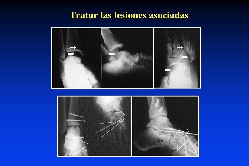 Tratar las lesiones asociadas 