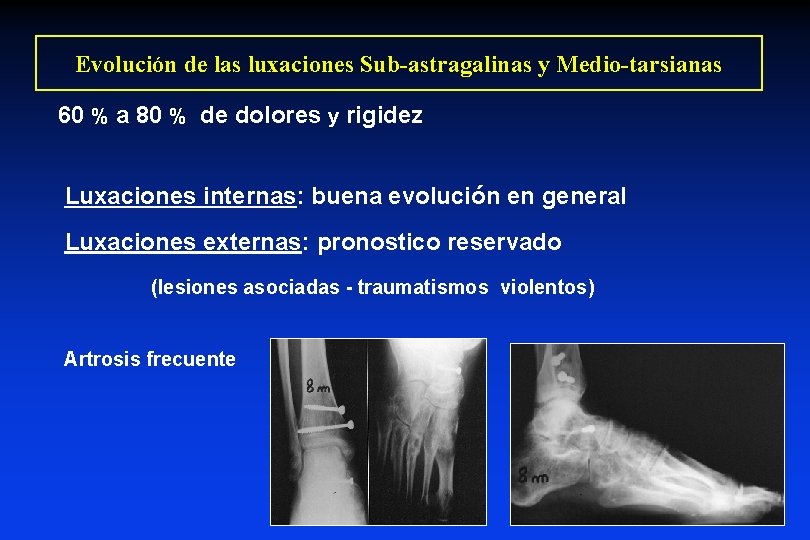Evolución de las luxaciones Sub-astragalinas y Medio-tarsianas 60 % a 80 % de dolores