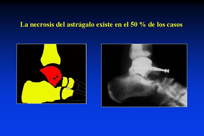 La necrosis del astrágalo existe en el 50 % de los casos 