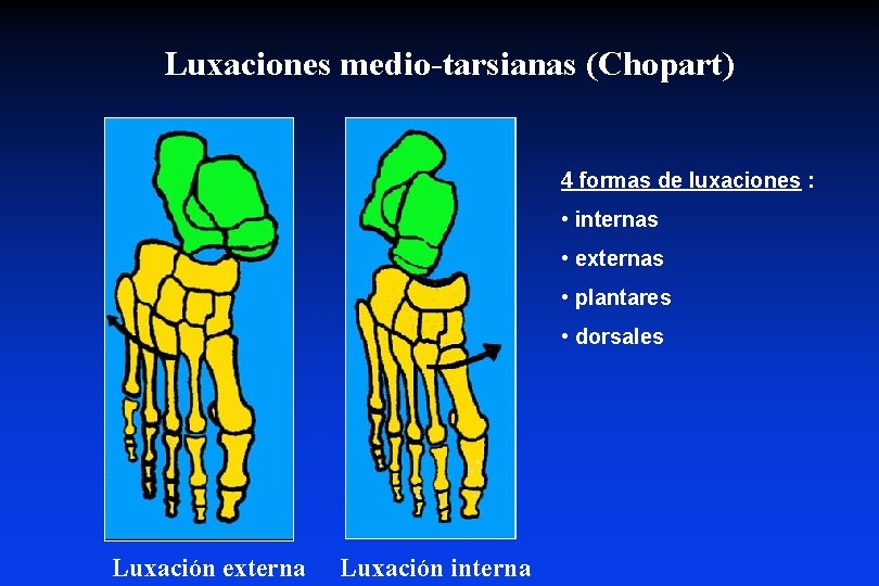 Luxaciones medio-tarsianas (Chopart) 4 formas de luxaciones : • internas • externas • plantares