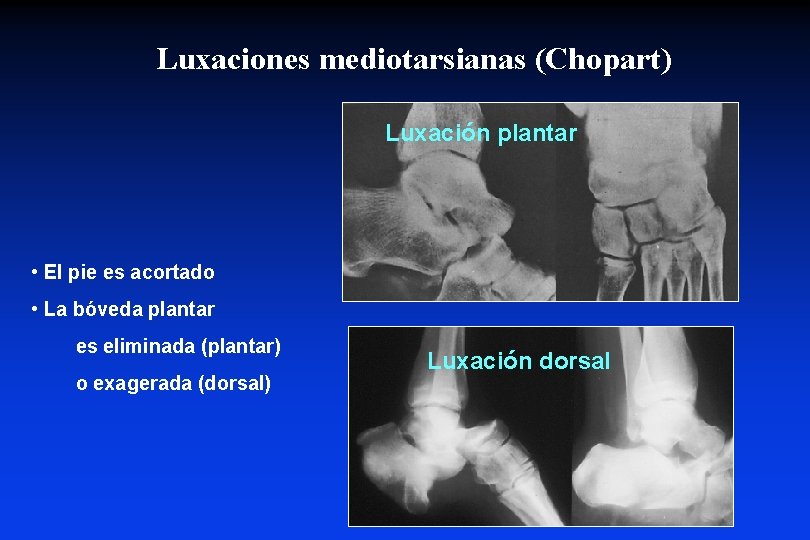 Luxaciones mediotarsianas (Chopart) Luxación plantar • El pie es acortado • La bóveda plantar