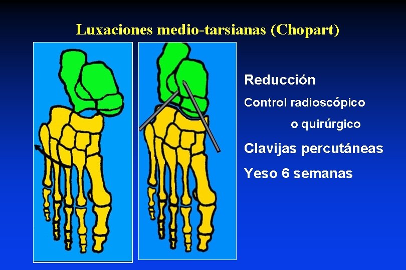Luxaciones medio-tarsianas (Chopart) Reducción Control radioscópico o quirúrgico Clavijas percutáneas Yeso 6 semanas 