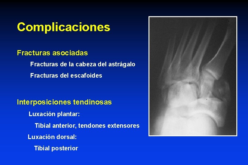 Complicaciones Fracturas asociadas Fracturas de la cabeza del astrágalo Fracturas del escafoides Interposiciones tendinosas