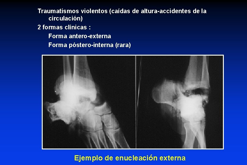 Traumatismos violentos (caídas de altura-accidentes de la circulación) 2 formas clínicas : Forma antero-externa