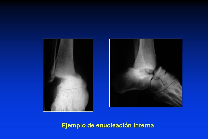 Ejemplo de enucleación interna 