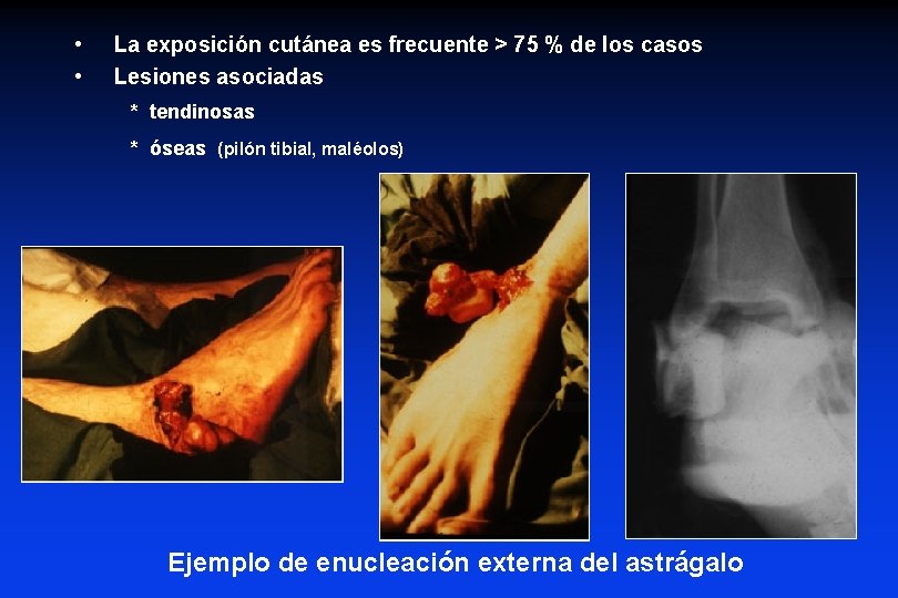  • • La exposición cutánea es frecuente > 75 % de los casos