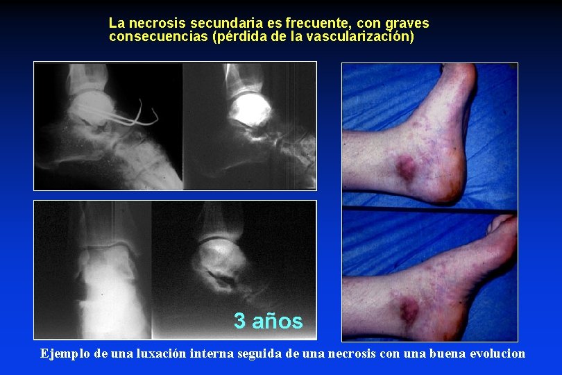 La necrosis secundaria es frecuente, con graves consecuencias (pérdida de la vascularización) 3 años
