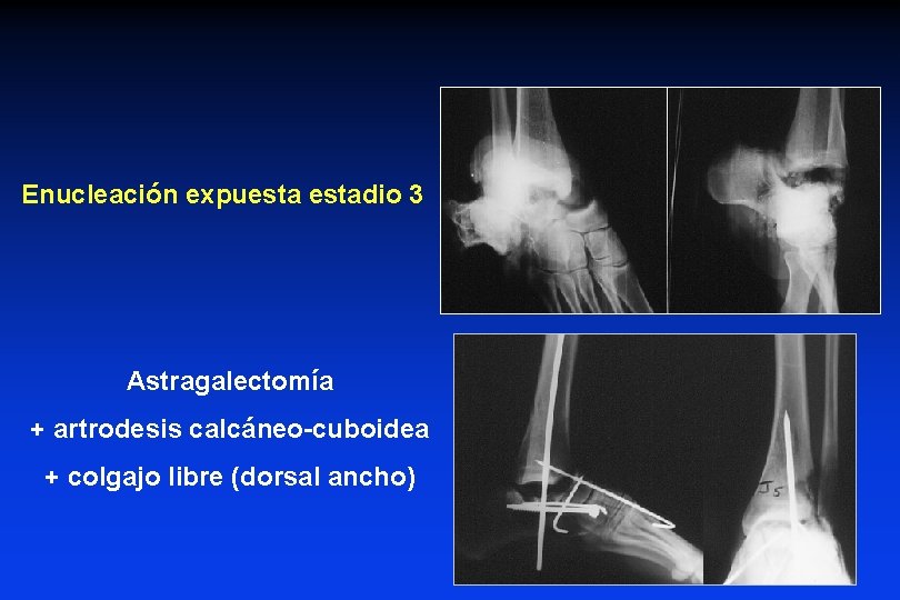 Enucleación expuestadio 3 Astragalectomía + artrodesis calcáneo-cuboidea + colgajo libre (dorsal ancho) 