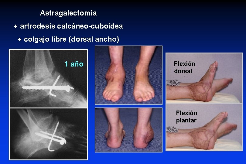 Astragalectomía + artrodesis calcáneo-cuboidea + colgajo libre (dorsal ancho) 1 año Flexión dorsal Flexión