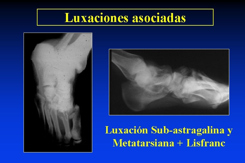 Luxaciones asociadas Luxación Sub-astragalina y Metatarsiana + Lisfranc 