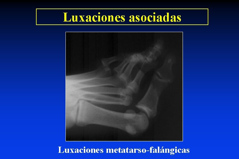 Luxaciones asociadas Luxaciones metatarso-falángicas 