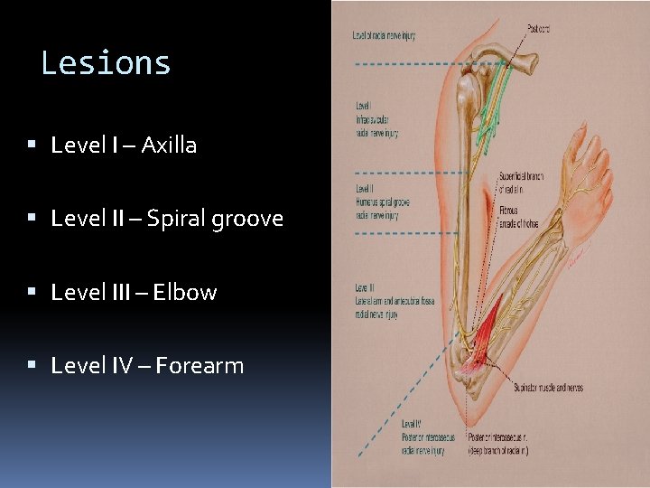 Lesions Level I – Axilla Level II – Spiral groove Level III – Elbow