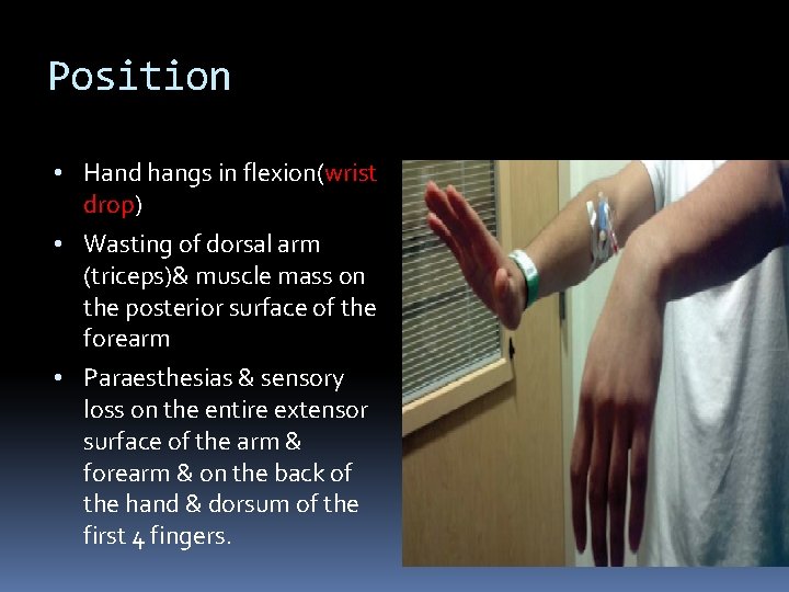 Position • Hand hangs in flexion(wrist drop) • Wasting of dorsal arm (triceps)& muscle