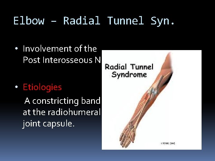 Elbow – Radial Tunnel Syn. • Involvement of the Post Interosseous N. • Etiologies