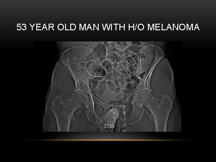 53 YEAR OLD MAN WITH H/O MELANOMA 