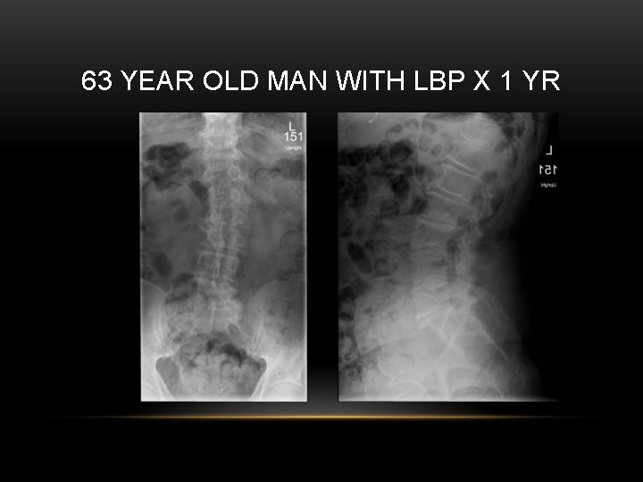 63 YEAR OLD MAN WITH LBP X 1 YR 